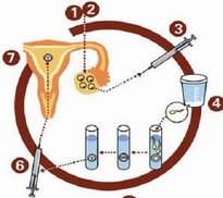 哪个是较好的试管婴儿方案？常用的排卵方案是什么？